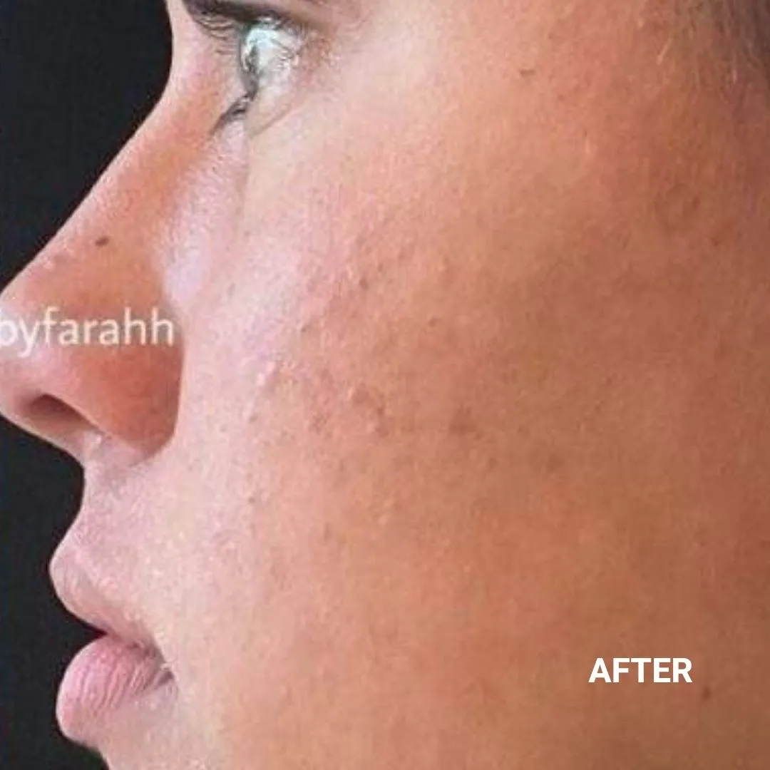 After Non-Invasive Gloss Plasma Acne Treatment - Cheeks