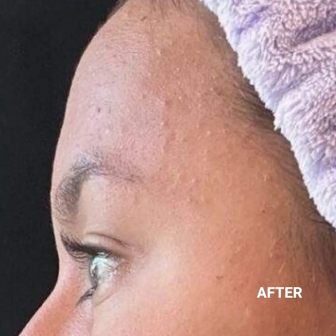 After Non-Invasive Gloss Plasma Acne Treatment - Forehead