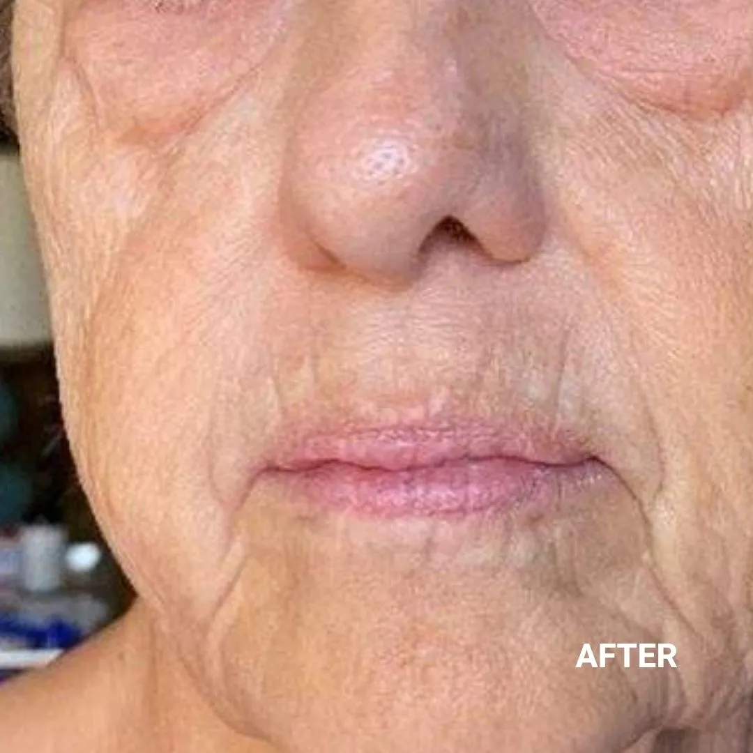 After Non-Invasive Gloss Plasma Skin Lifting - Ageing Cheek Chin Wrinkles Smile Lines