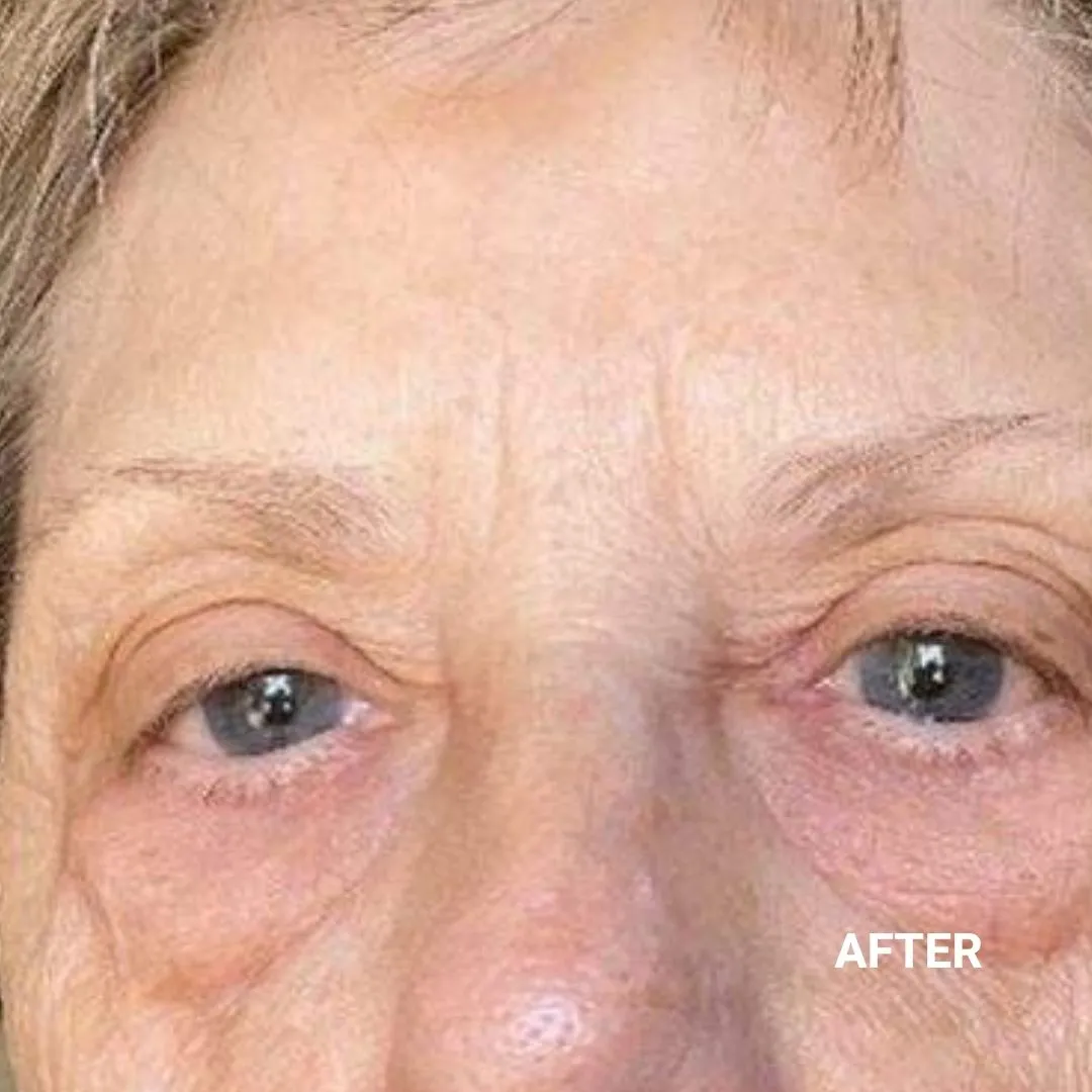 After Non-Invasive Gloss Plasma Skin Lifting - Ageing Eye Bags and Crow Feet