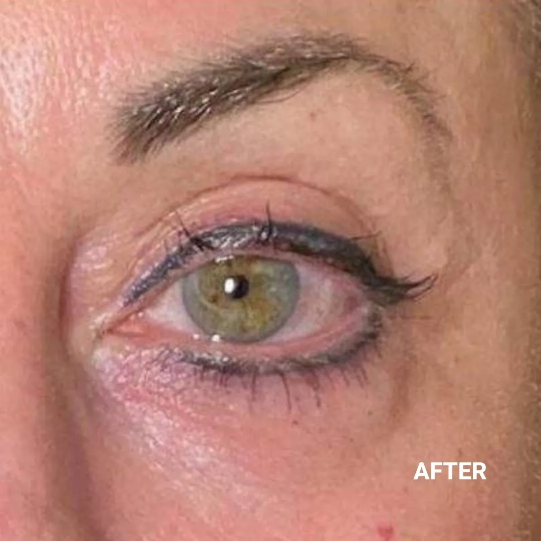 After Non-Invasive Gloss Plasma Skin Lifting - Ageing Eyebag and Crow Feet Wrinkles