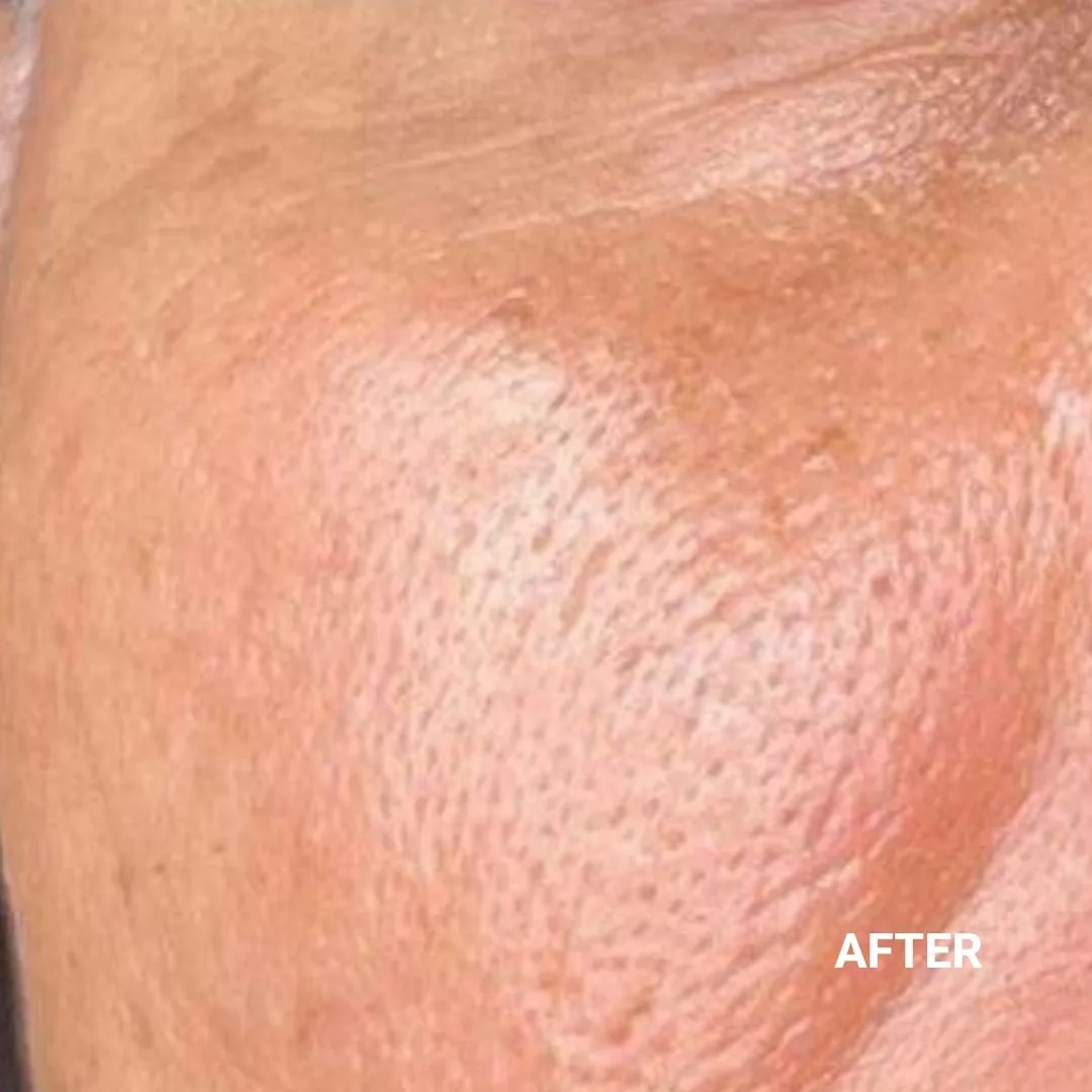After Non-Invasive Gloss Plasma Skin Lifting - Ageing Man Cheeks