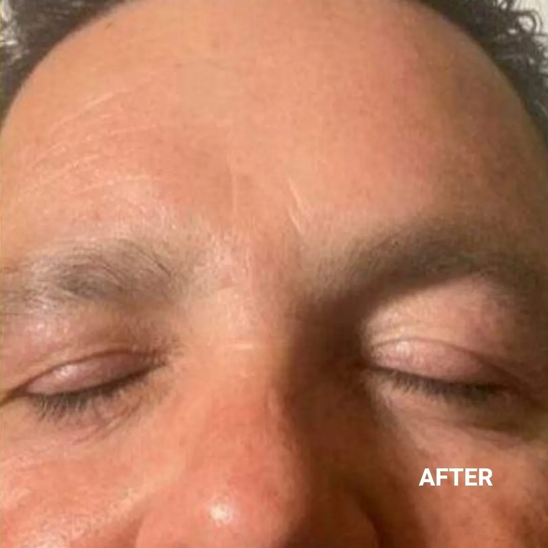 After Non-Invasive Gloss Plasma Skin Lifting - Ageing Man Forehead Wrinkles