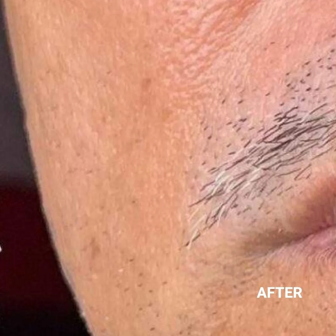 After Non-Invasive Gloss Plasma Skin Lifting - Ageing Man Smile Lines