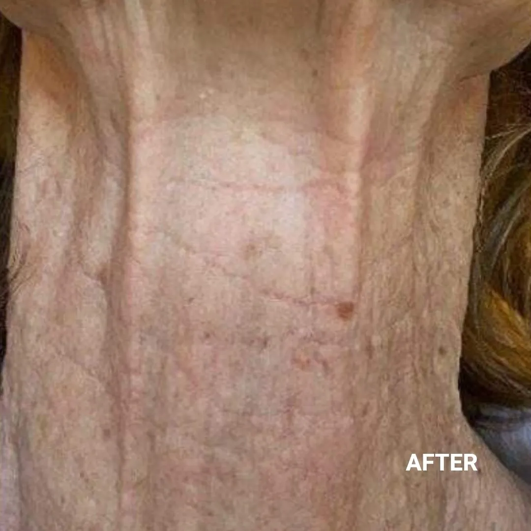 After Non-Invasive Gloss Plasma Skin Lifting - Ageing Neck Wrinkles