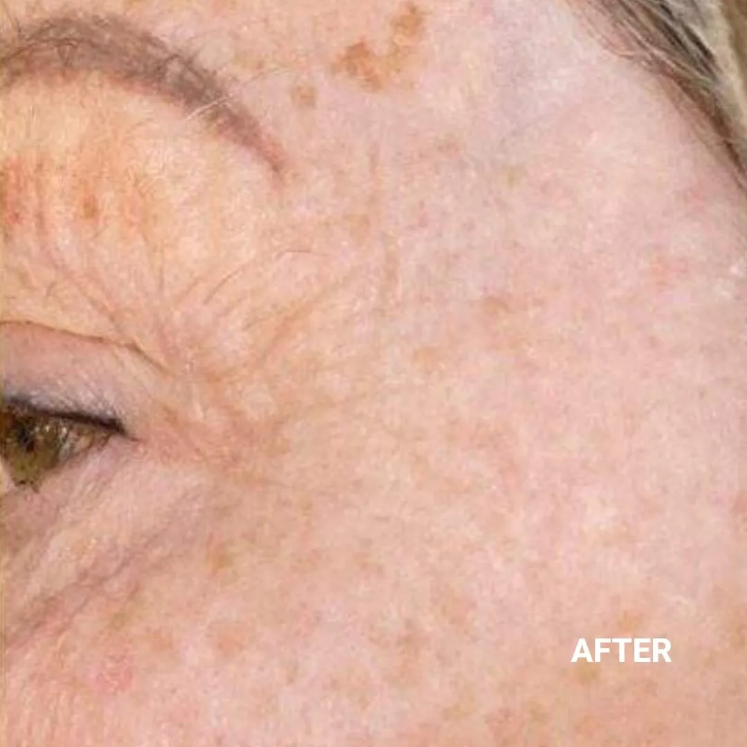 After Non-Invasive Gloss Plasma Skin Lifting - Ageing Pigmentation Spots and Crow Feet Wrinkles