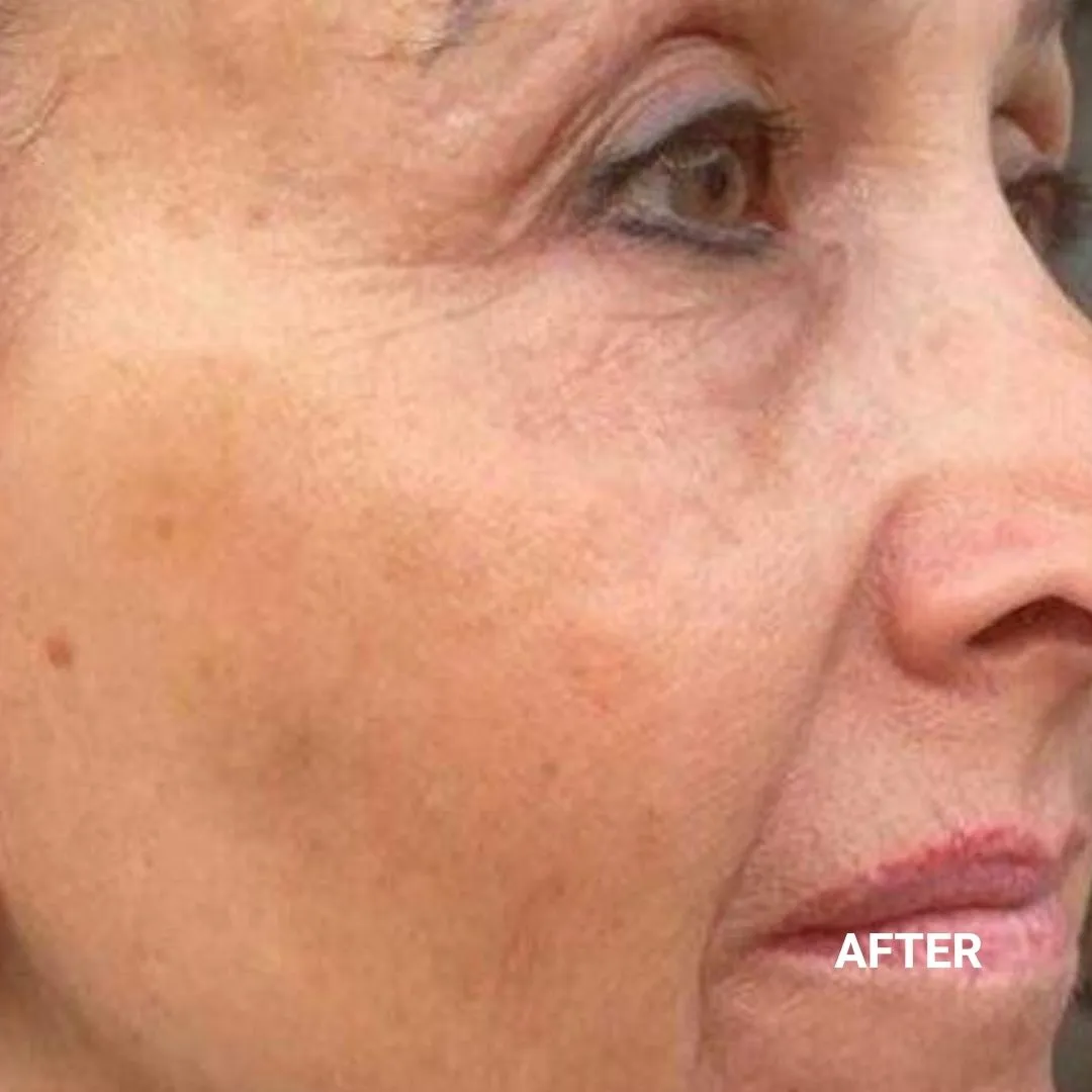 After Non-Invasive Gloss Plasma Skin Lifting - Ageing Pigmentation Spots Cheeks Smile Lines