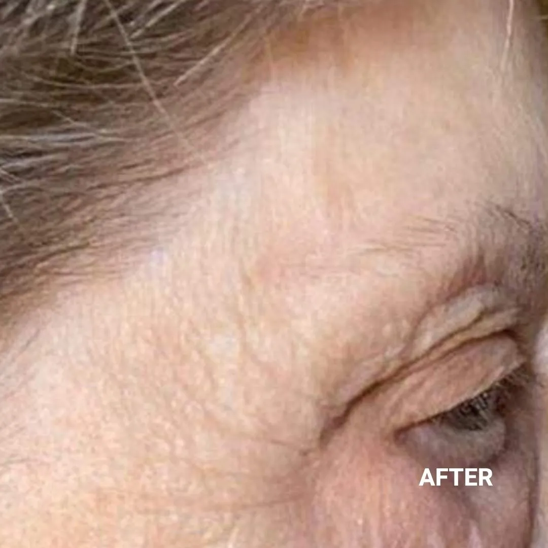 After Non-Invasive Gloss Plasma Skin Lifting - Asian Crow Feet Wrinkles Treated