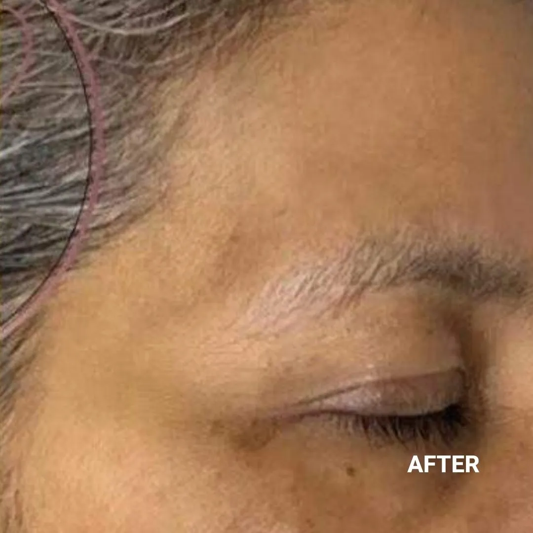 After Non-Invasive Gloss Plasma Skin Lifting - Asian Crow Feets Treated