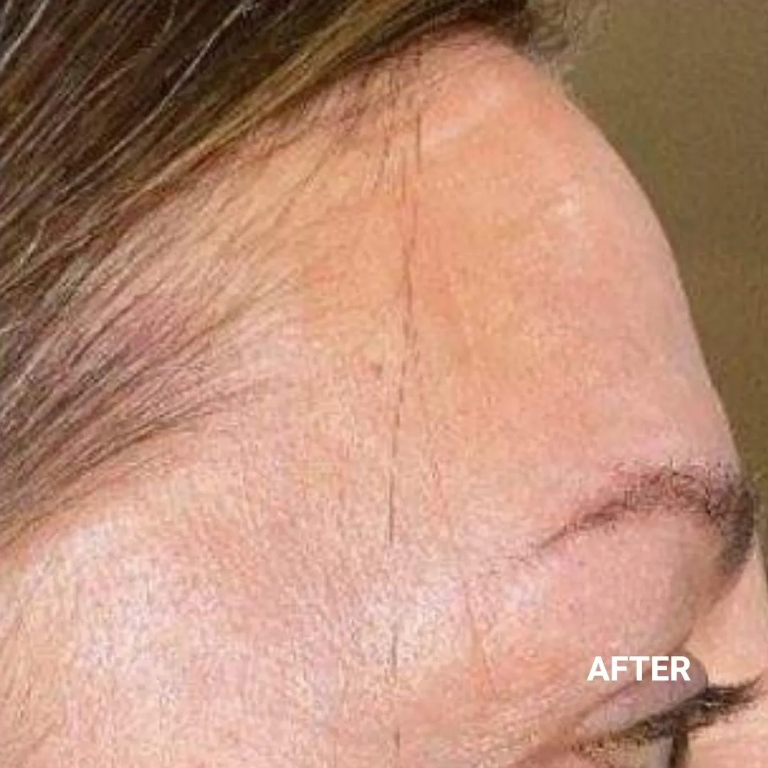 After Non-Invasive Gloss Plasma Skin Lifting - Asian Forehead Wrinkles Treated