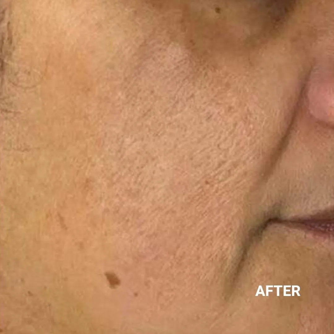 After Non-Invasive Gloss Plasma Skin Lifting - Asian Sagging Face Wrinkles Pigmentation