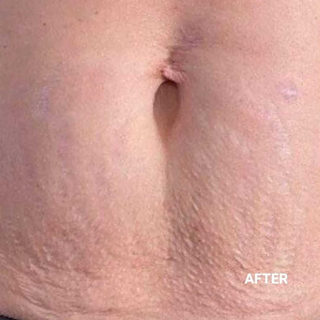 After Non-Invasive Gloss Plasma Skin Lifting - Belly Stretch Marks