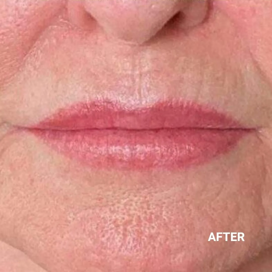 After Non-Invasive Gloss Plasma Skin Lifting - Chin Wrinkles Smile Lines Marionette lines