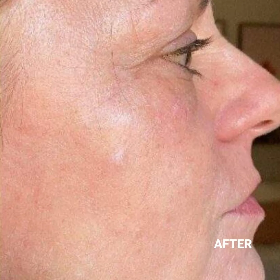 After Non-Invasive Gloss Plasma Skin Lifting - Crow Feet Wrinkles Treated