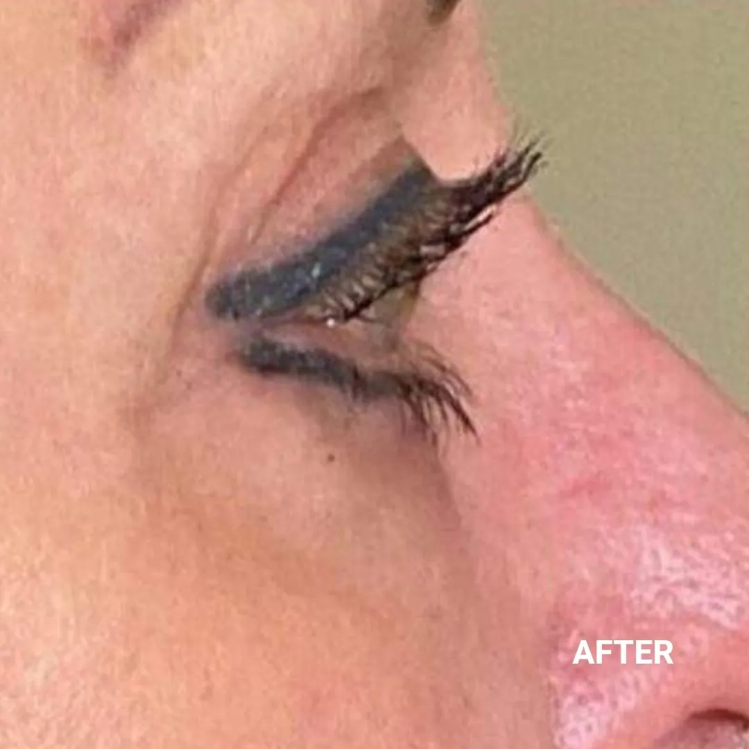 After Non-Invasive Gloss Plasma Skin Lifting - Eyebag and crow feet
