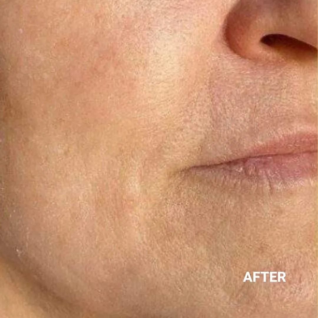 After Non-Invasive Gloss Plasma Skin Lifting - Eyebag and crow feet