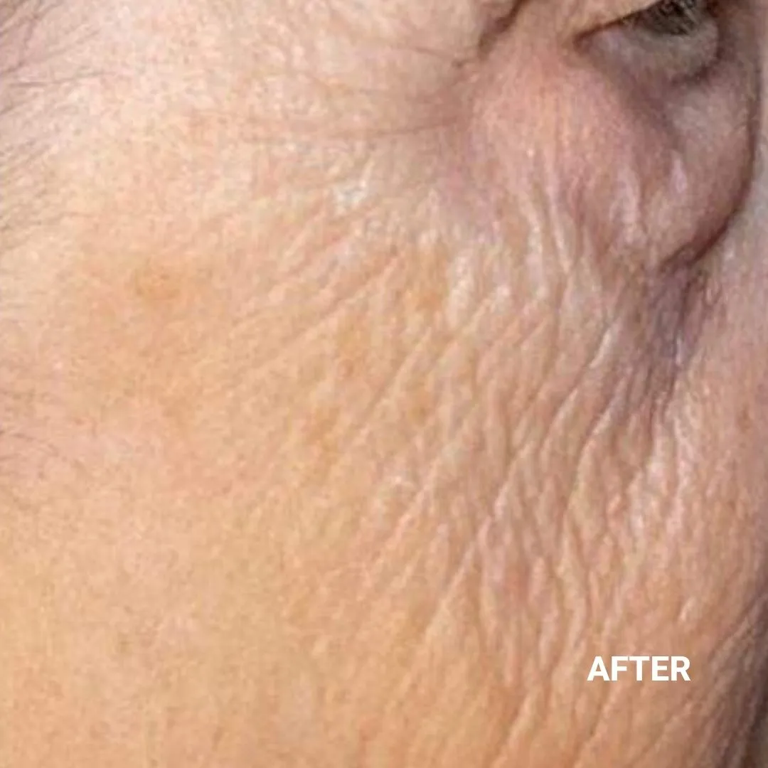 After Non-Invasive Gloss Plasma Skin Lifting - Old Cheeks Wrinkles
