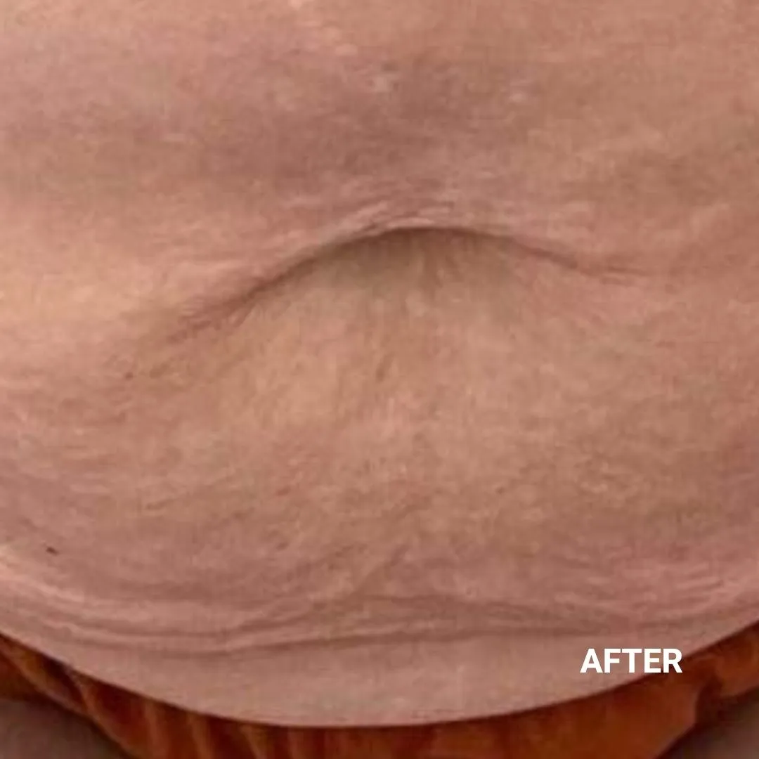 After Non-Invasive Gloss Plasma Skin Lifting - Pregnancy Stretch Marks