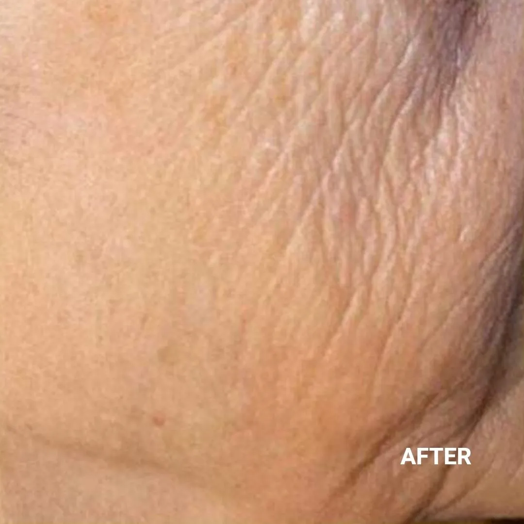 After Non-Invasive Gloss Plasma Skin Lifting - Sagging Cheeks and Smile Lines