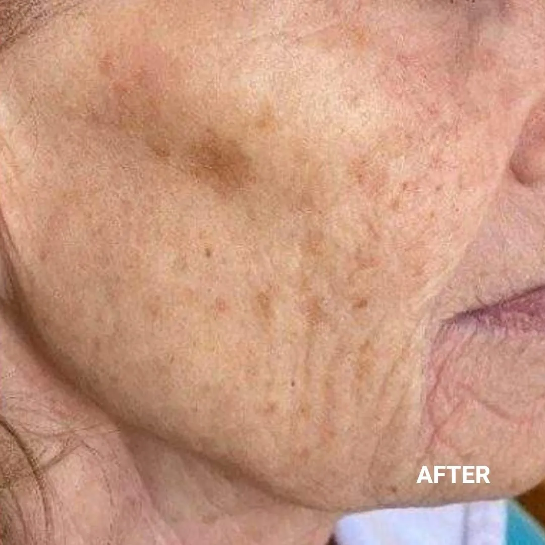 After Non-Invasive Gloss Plasma Skin Lifting - Sagging Face