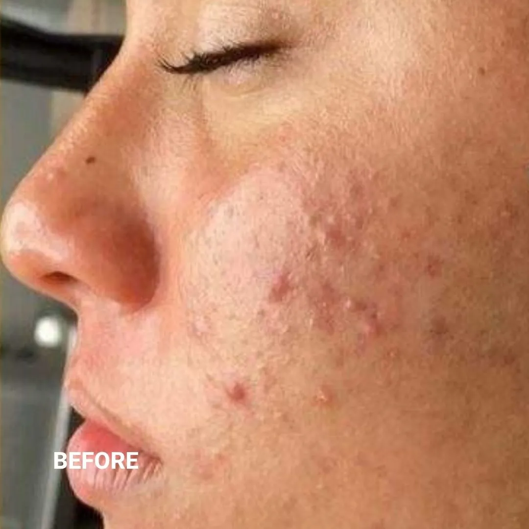 Before Non-Invasive Gloss Plasma Acne Treatment - Cheeks