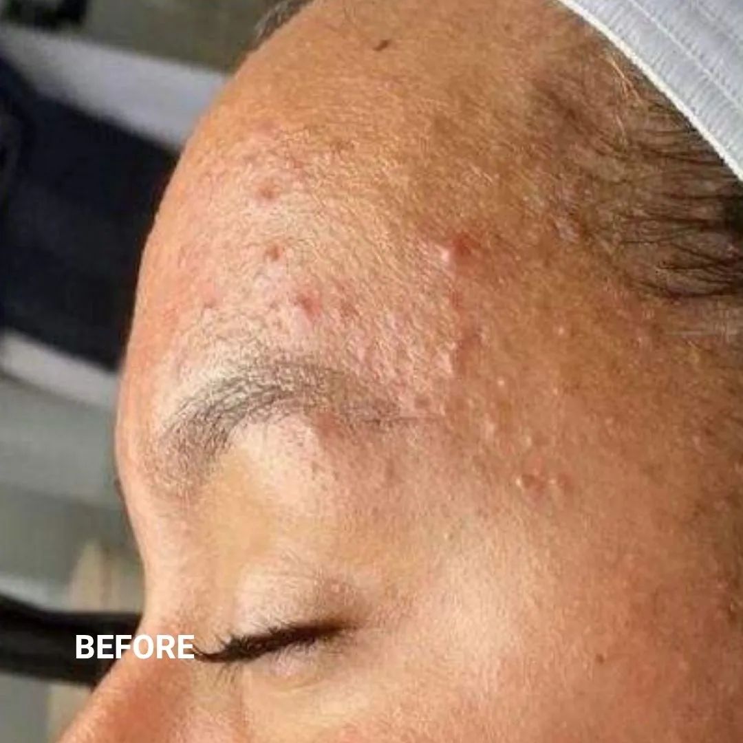 Before Non-Invasive Gloss Plasma Acne Treatment - Forehead