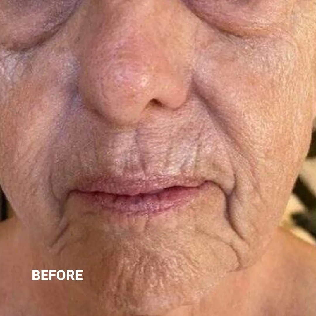 Before Non-Invasive Gloss Plasma Skin Lifting - Ageing Cheek Chin Wrinkles Smile Lines