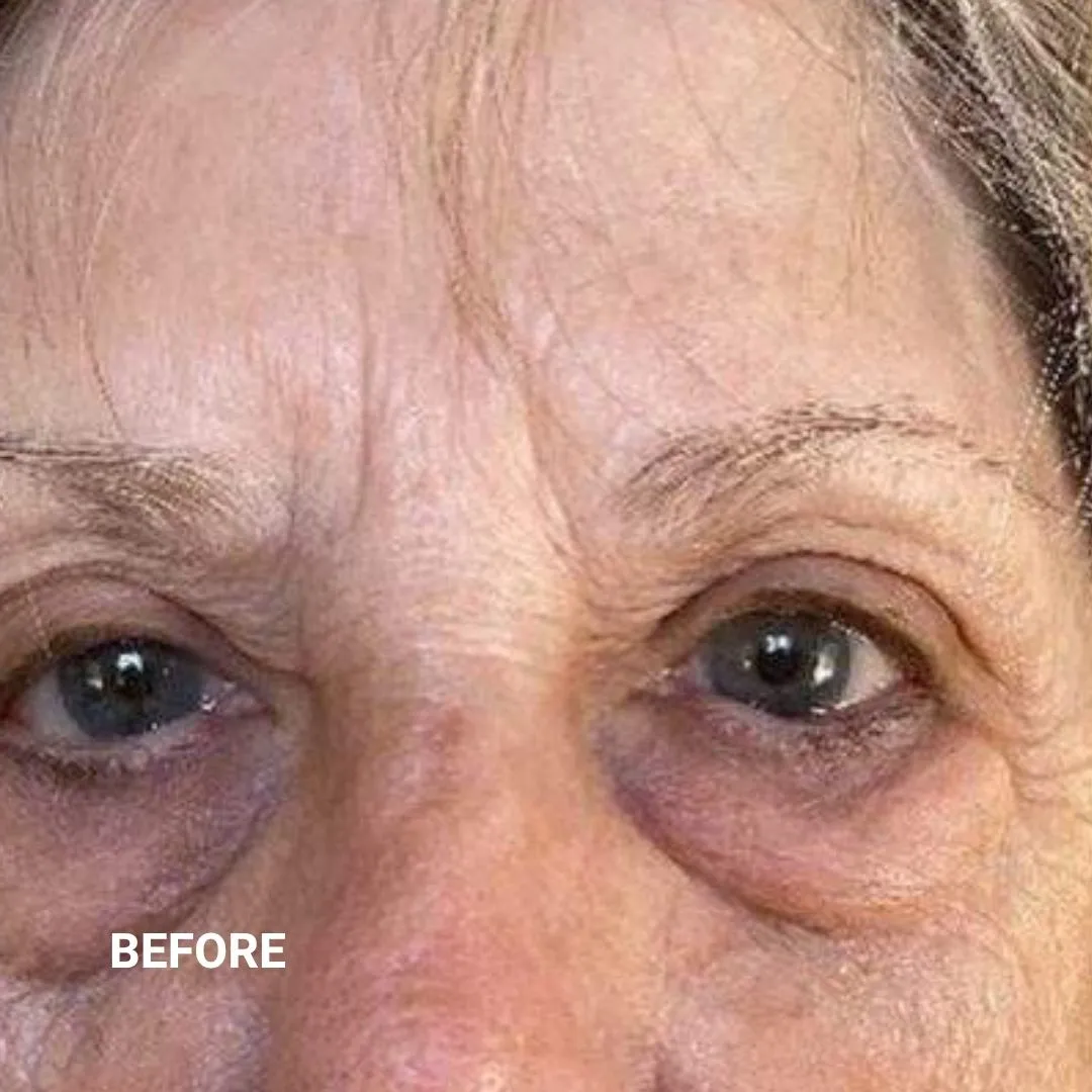Before Non-Invasive Gloss Plasma Skin Lifting - Ageing Eye Bags and Crow Feet