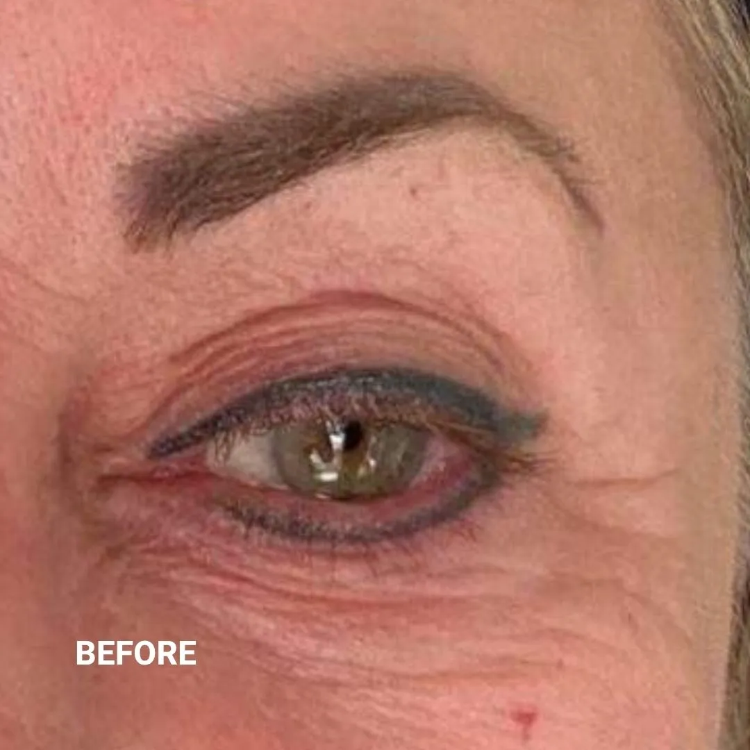 Before Non-Invasive Gloss Plasma Skin Lifting - Ageing Eyebag and Crow Feet Wrinkles