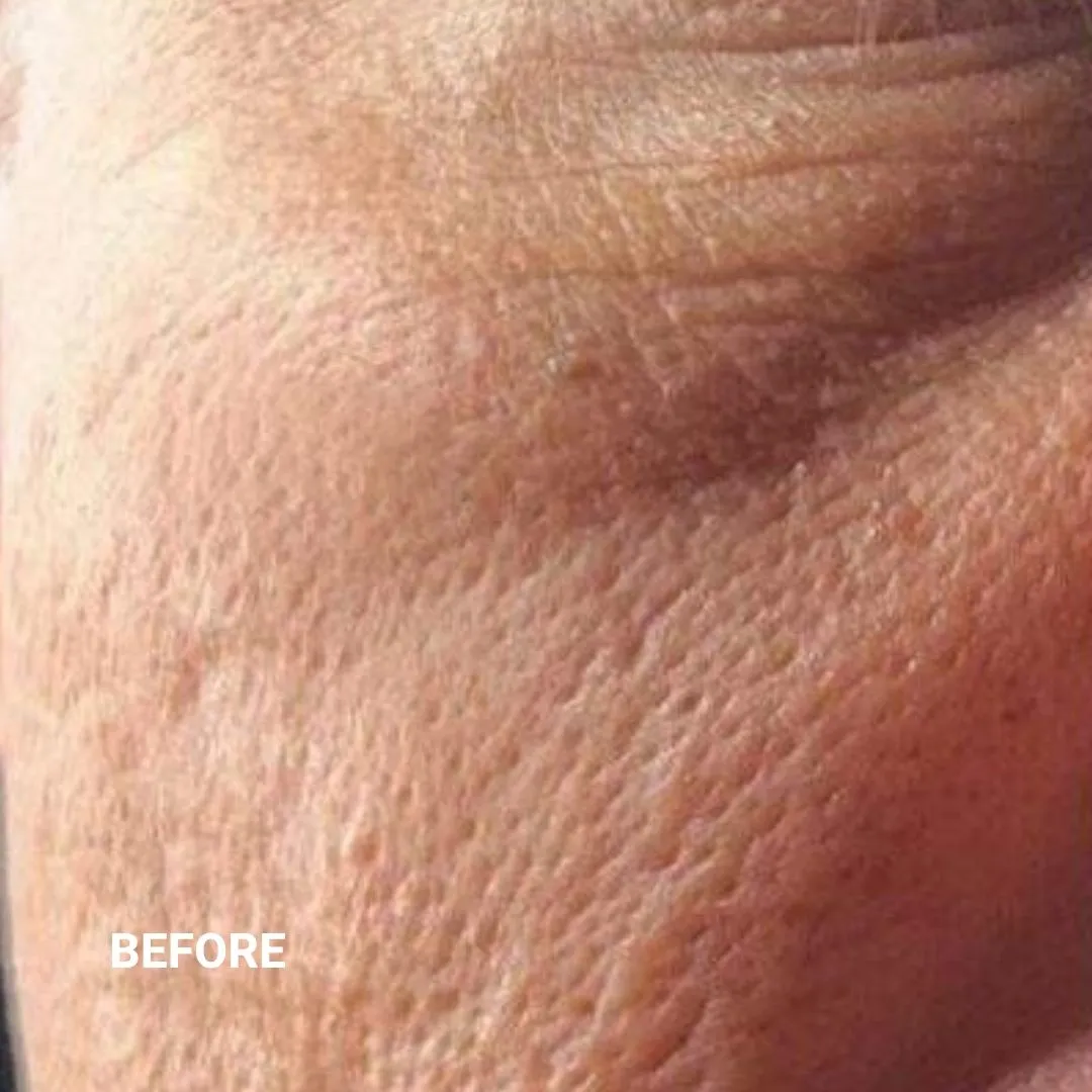 Before Non-Invasive Gloss Plasma Skin Lifting - Ageing Man Cheeks