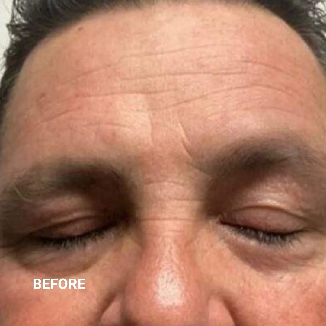 Before Non-Invasive Gloss Plasma Skin Lifting - Ageing Man Forehead Wrinkles