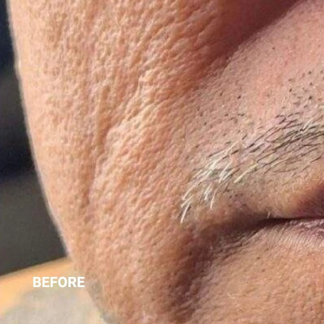 Before Non-Invasive Gloss Plasma Skin Lifting - Ageing Man Smile Lines