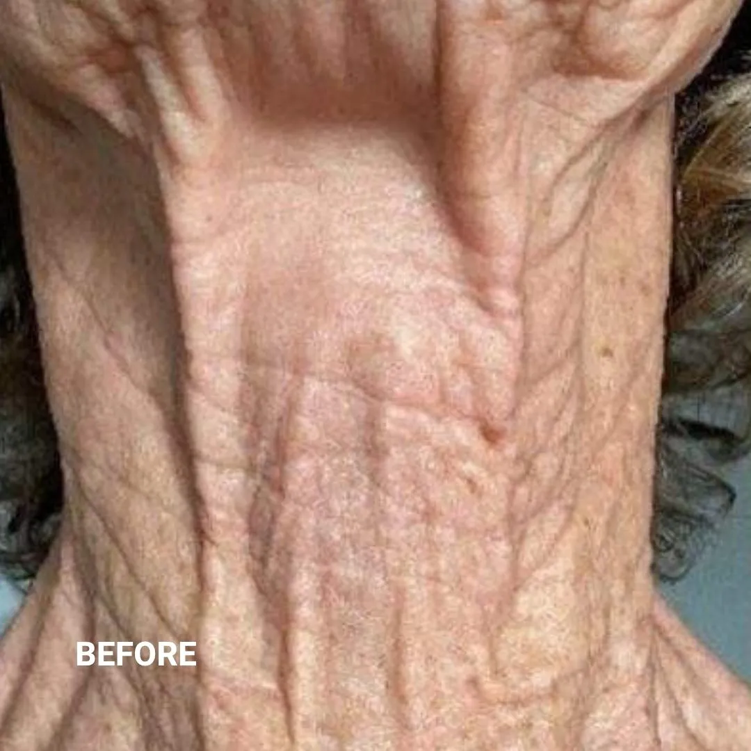 Before Non-Invasive Gloss Plasma Skin Lifting - Ageing Neck Wrinkles