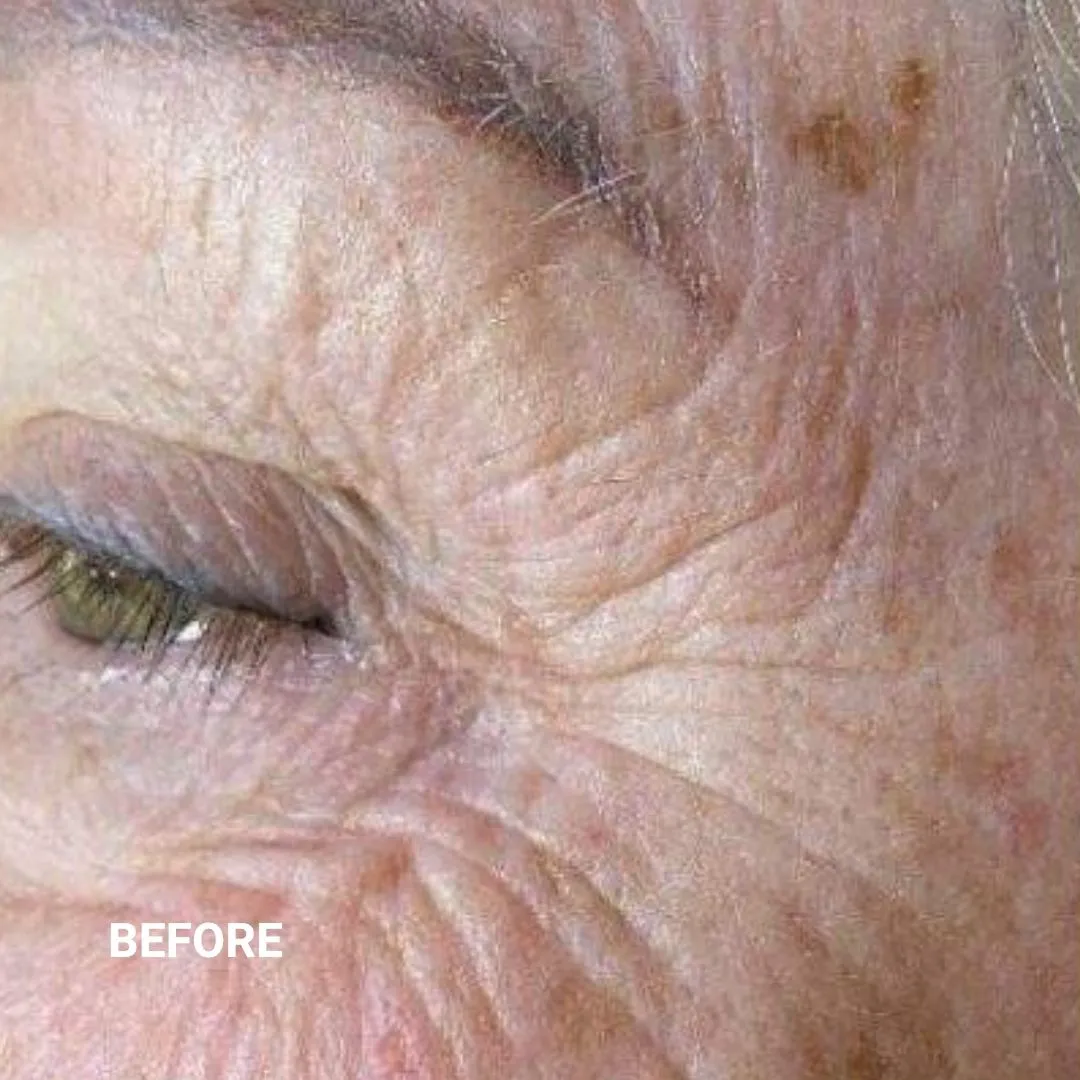 Before Non-Invasive Gloss Plasma Skin Lifting - Ageing Pigmentation Spots and Crow Feet Wrinkles