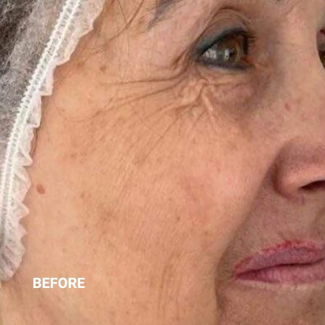 Before Non-Invasive Gloss Plasma Skin Lifting - Ageing Pigmentation Spots Cheeks Smile Lines