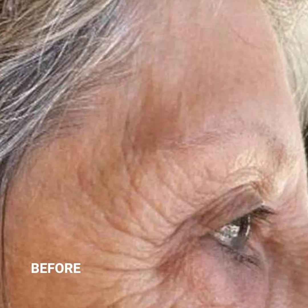 Before Non-Invasive Gloss Plasma Skin Lifting - Asian Crow Feet Wrinkles