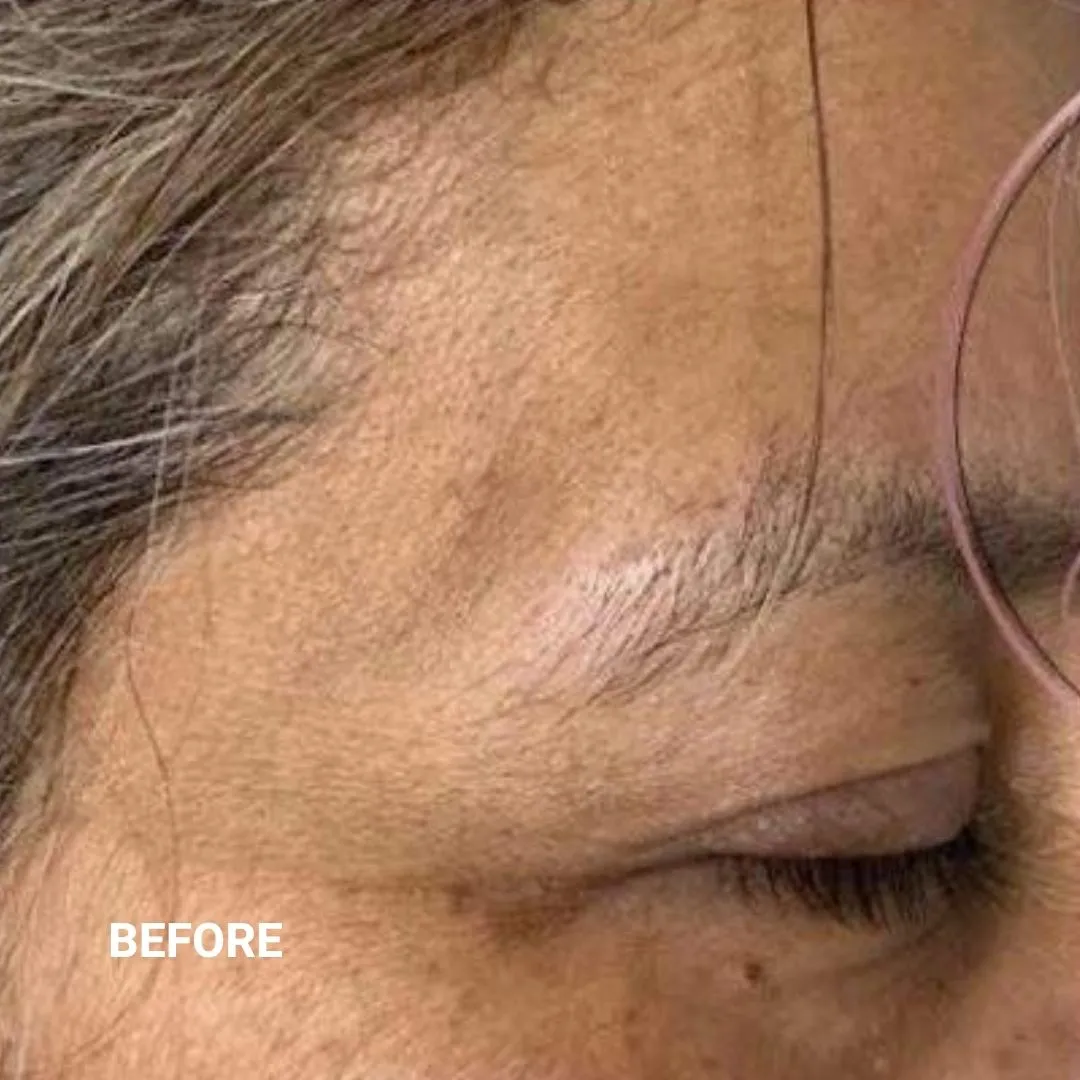 Before Non-Invasive Gloss Plasma Skin Lifting - Asian Crow Feets