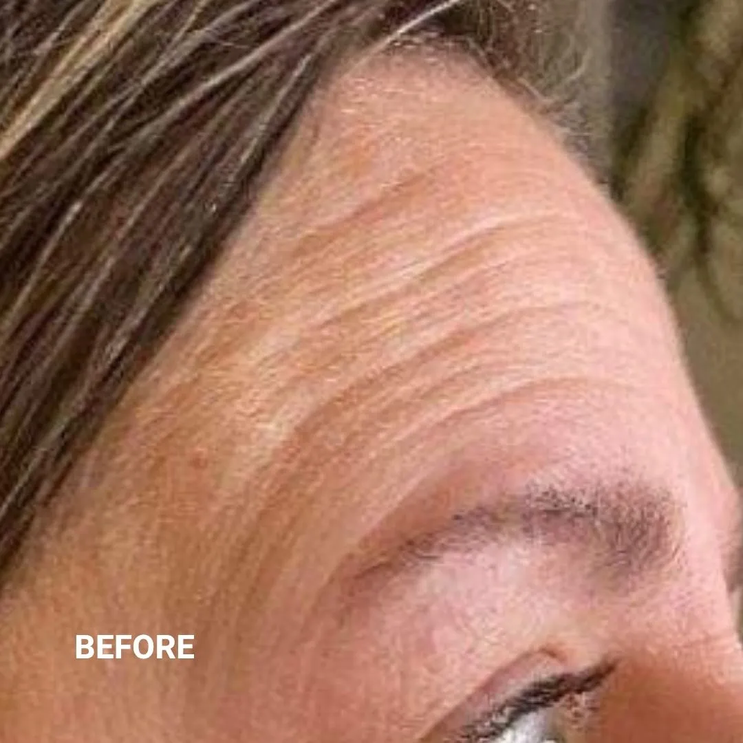 Before Non-Invasive Gloss Plasma Skin Lifting - Asian Forehead Wrinkles