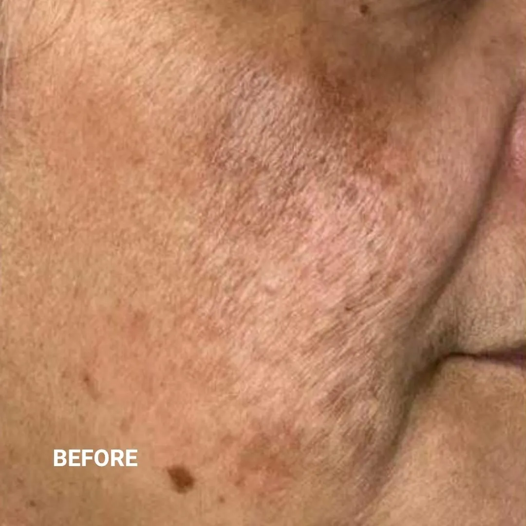 Before Non-Invasive Gloss Plasma Skin Lifting - Asian Sagging Face Wrinkles Pigmentation