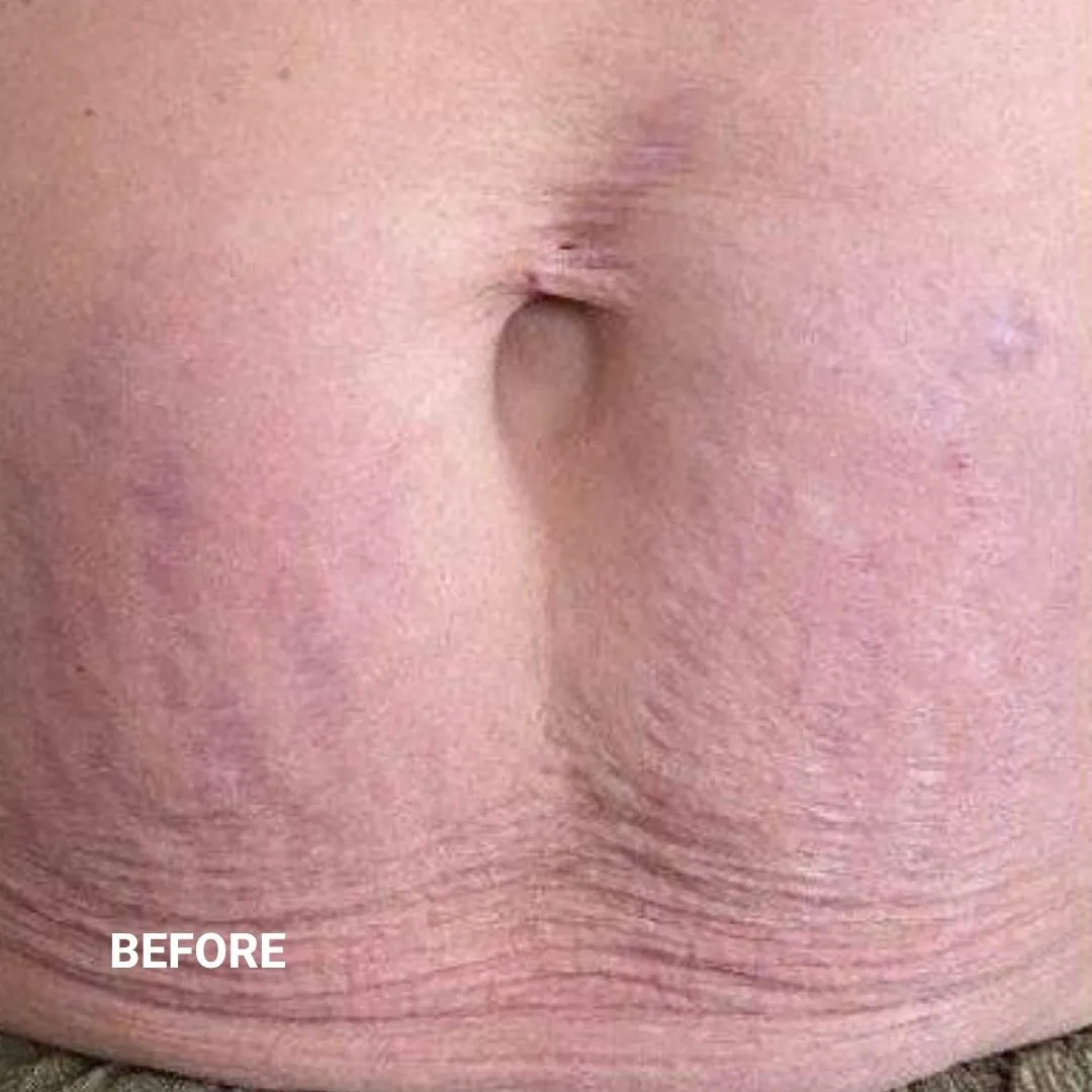 Before Non-Invasive Gloss Plasma Skin Lifting - Belly Stretch Marks