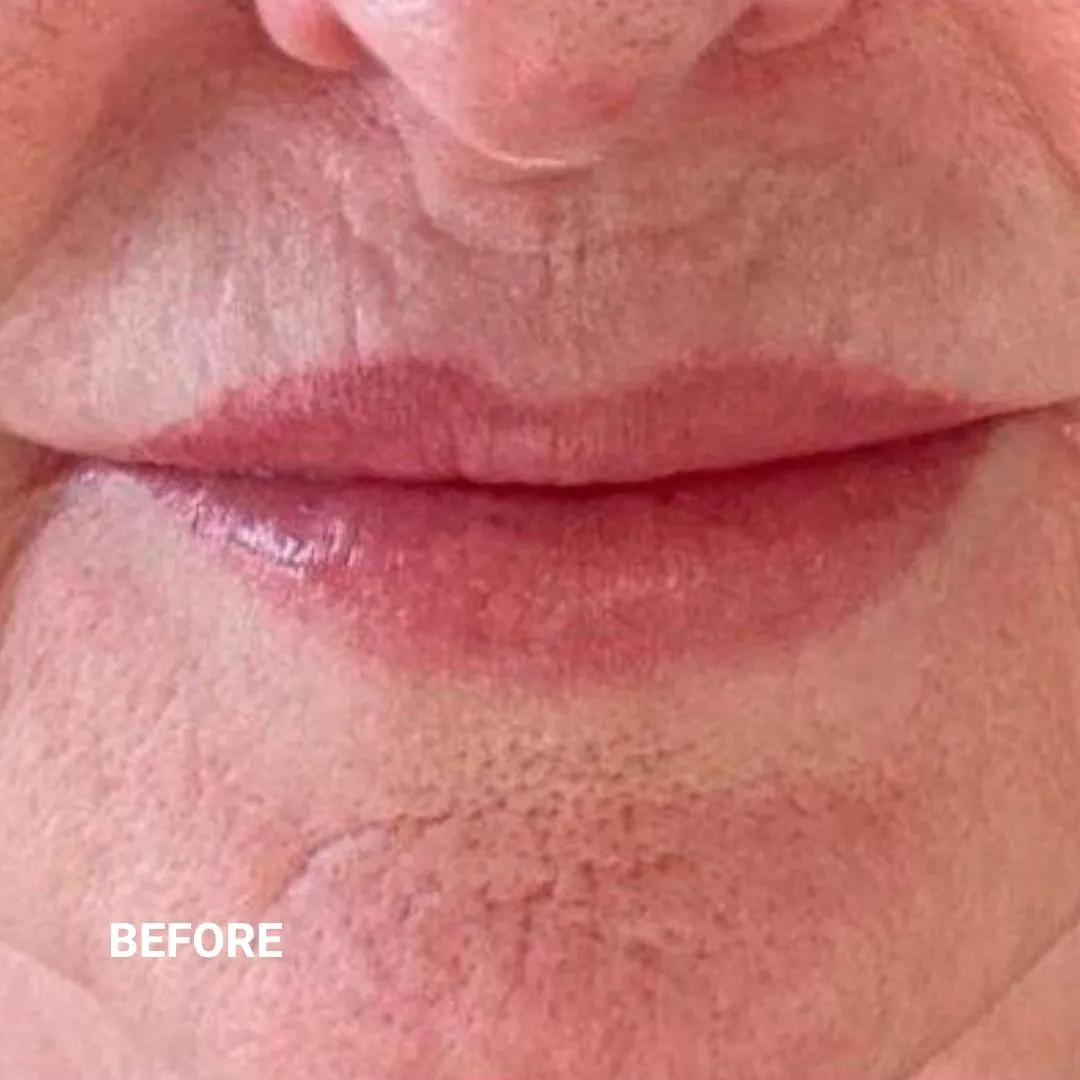 Before Non-Invasive Gloss Plasma Skin Lifting - Chin Wrinkles Smile Lines Marionette lines
