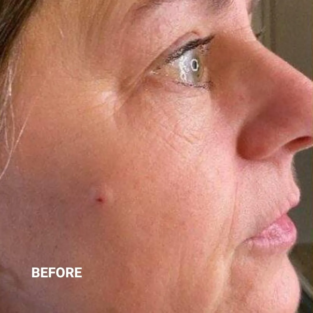 Before Non-Invasive Gloss Plasma Skin Lifting - Crow Feet Wrinkles