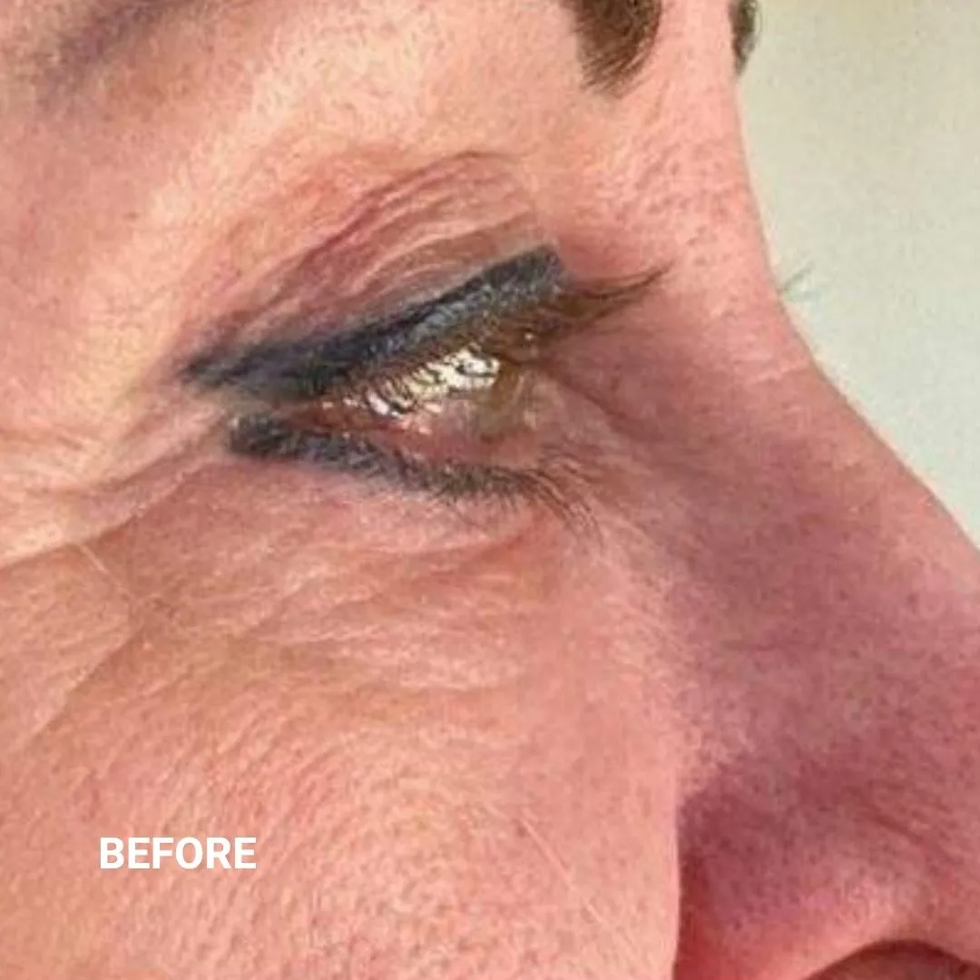 Before Non-Invasive Gloss Plasma Skin Lifting - Eyebag and crow feet