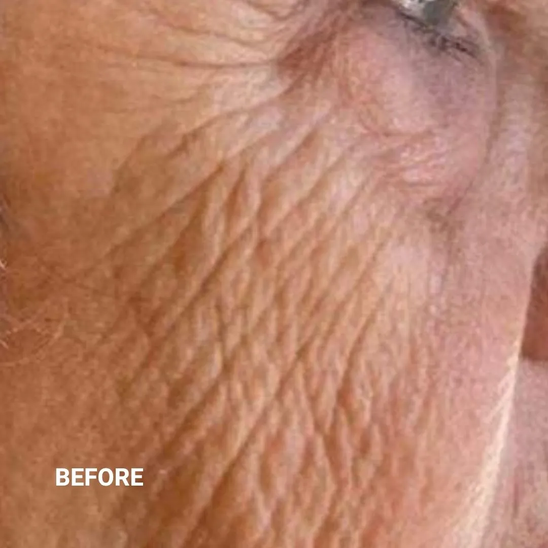 Before Non-Invasive Gloss Plasma Skin Lifting - Old Cheeks Wrinkles