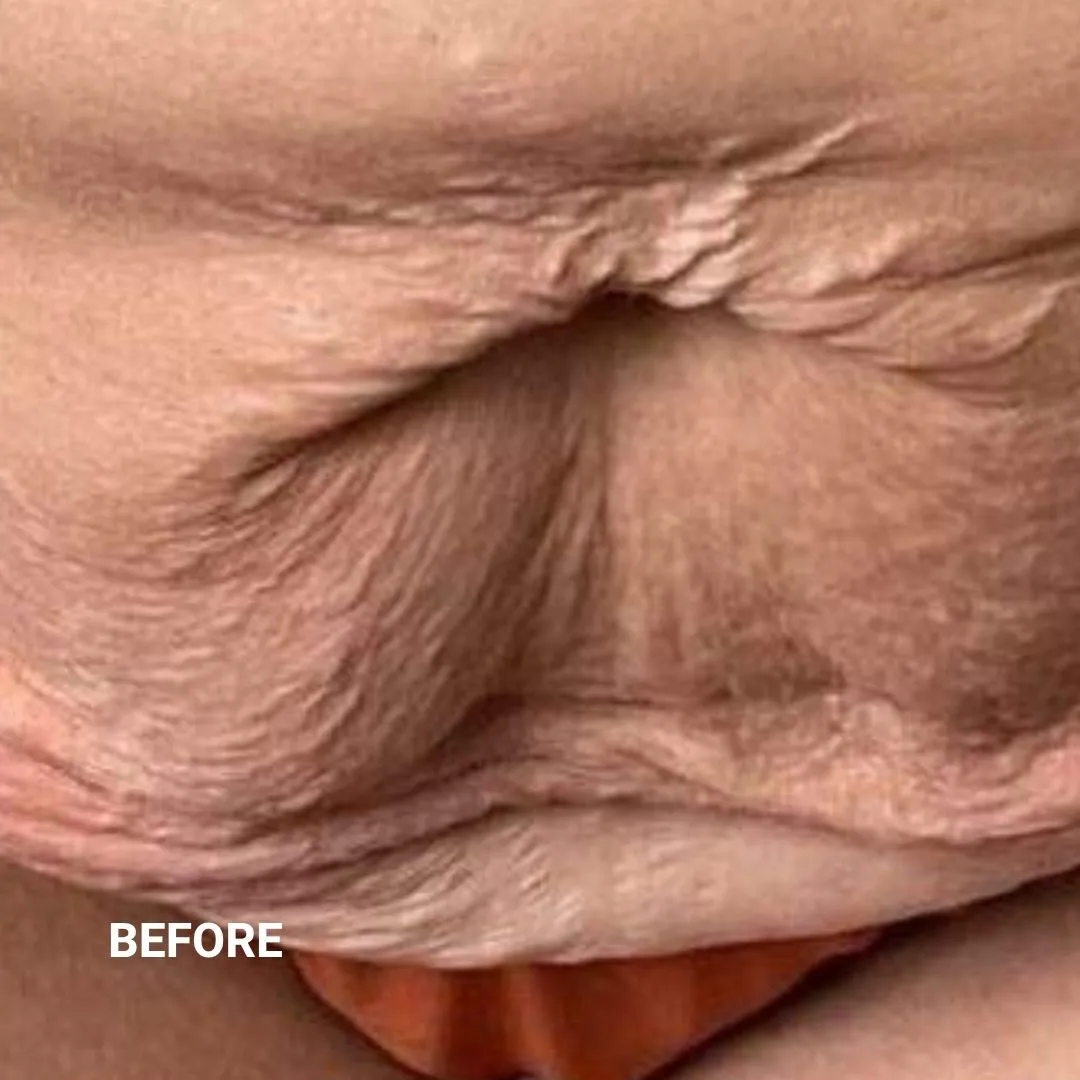 Before Non-Invasive Gloss Plasma Skin Lifting - Pregnancy Stretch Marks