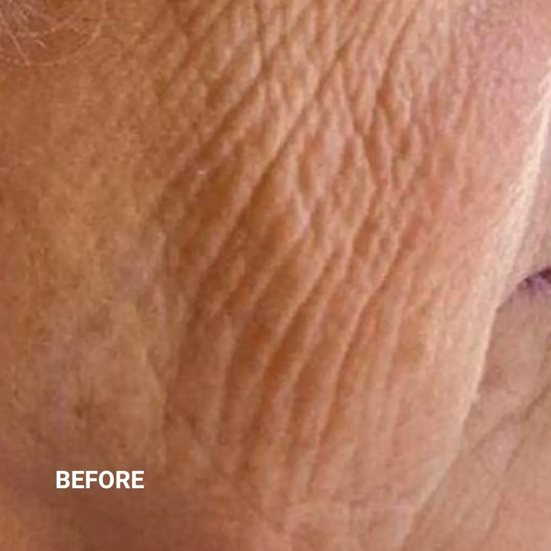 Before Non-Invasive Gloss Plasma Skin Lifting - Sagging Cheeks and Smile Lines