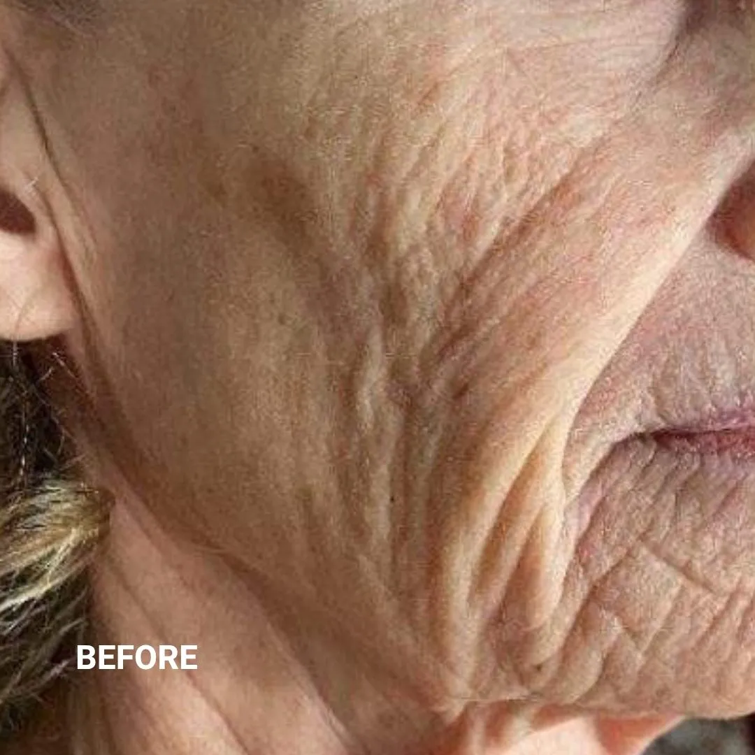 Before Non-Invasive Gloss Plasma Skin Lifting - Sagging Face