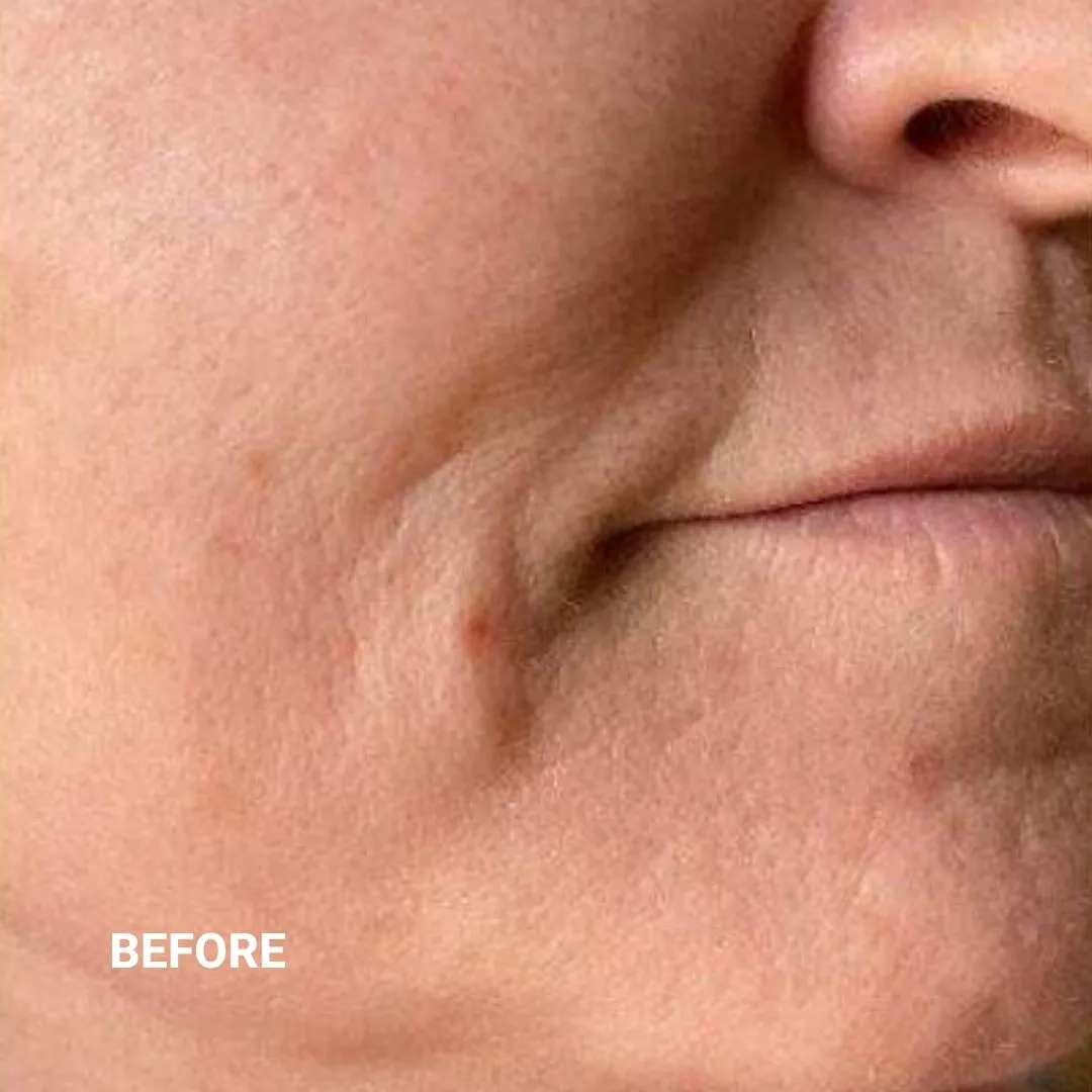 Before Non-Invasive Gloss Plasma Skin Lifting - Smile Lines