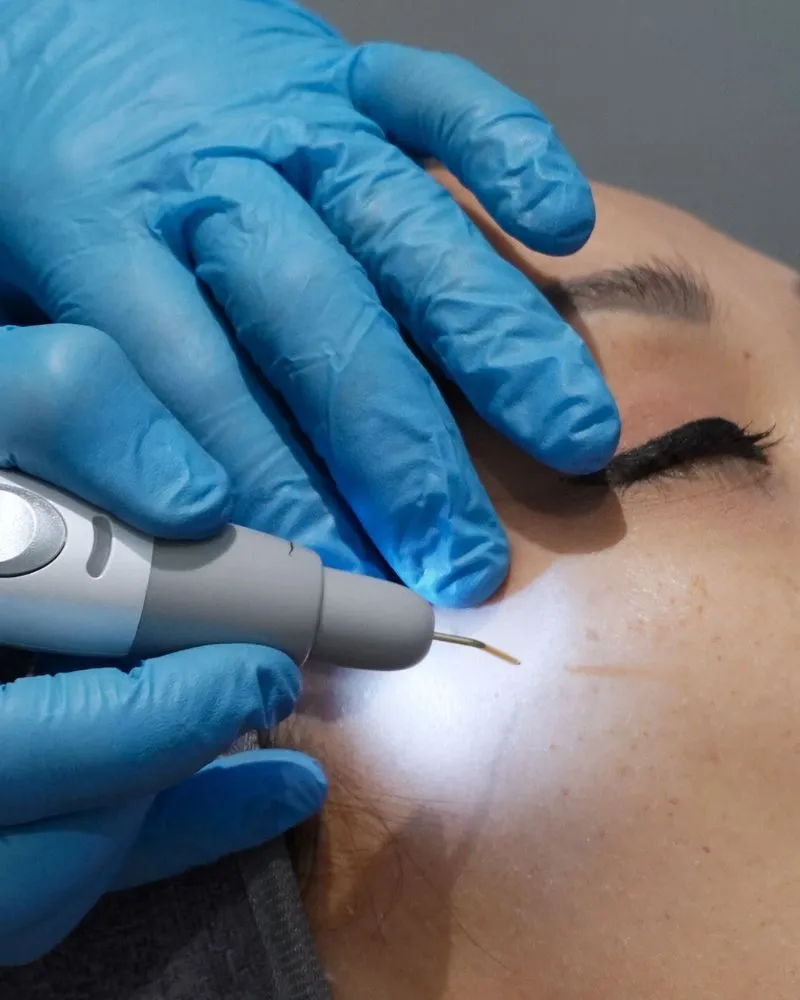 Gloss Hot Plasma Treatment for Pigmentation and Dark Spots Skin