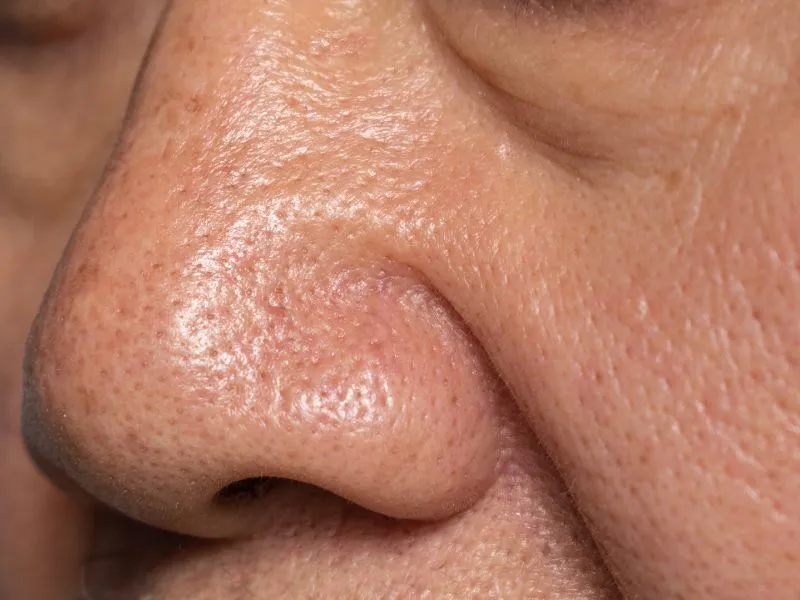 How To Treat Enlarged Pores In Singapore